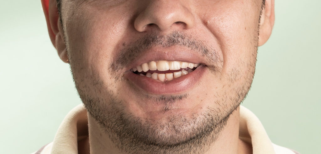 Coroane ceramice semi fizionomice la finalul tratamentul dentar