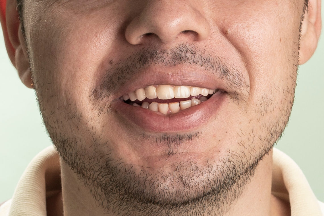 Coroane ceramice semi fizionomice la finalul tratamentul dentar