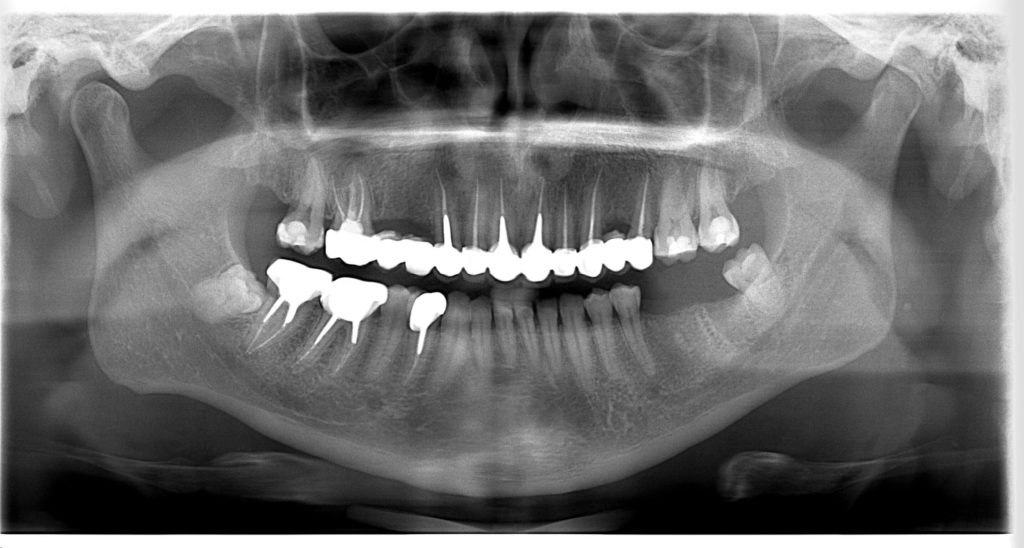 Radiografie de control dupa tratamentul dentar - Ioan Mihai